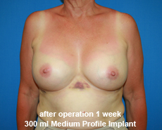 plastic-surgery-breast-augmentation